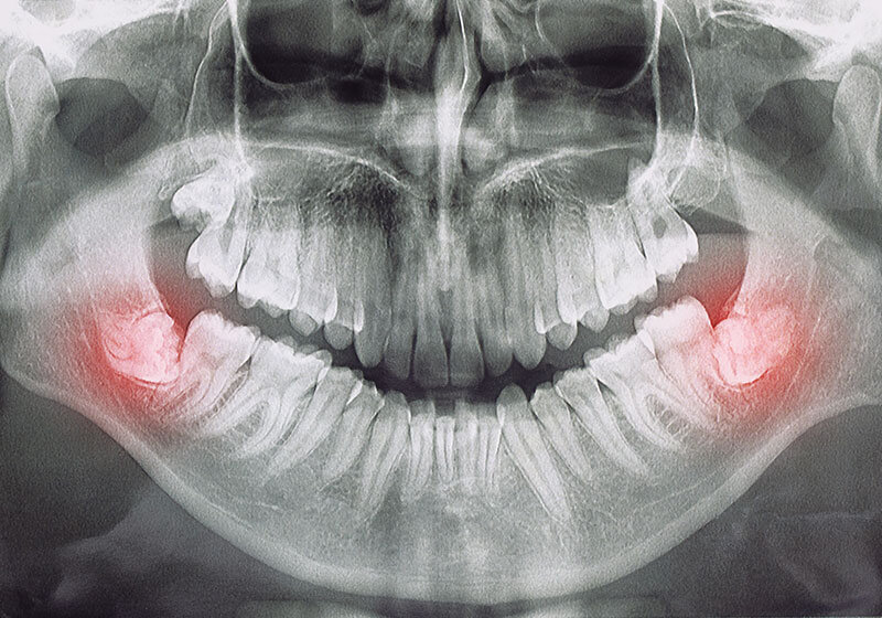 親知らずの抜歯は状態を精確に把握してから診断する