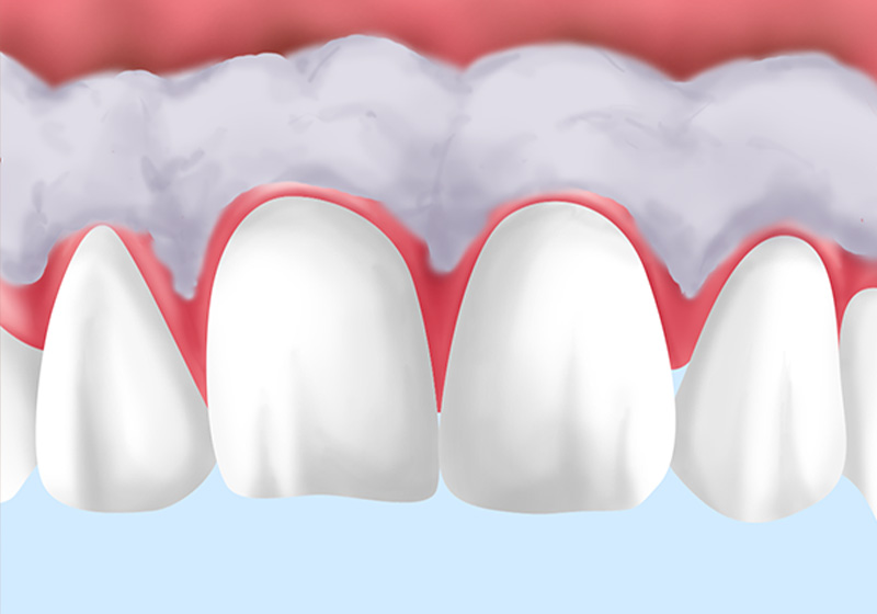 当院の歯肉漂白の治療法