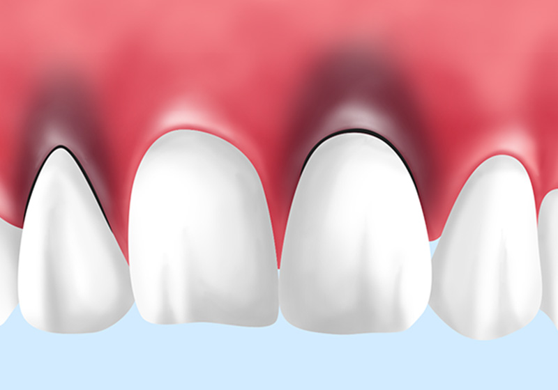 歯肉漂白の注意点