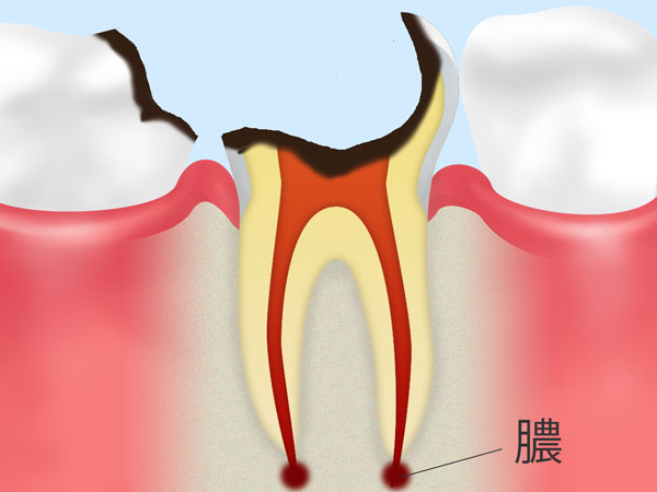 C4【歯根まで達した虫歯】