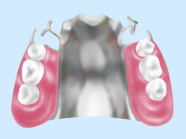 金属床義歯　【自費診療】