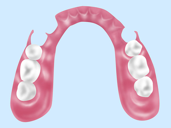 自費診療で来る入れ歯