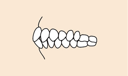 上下顎前突(じょうげがくぜんとつ)