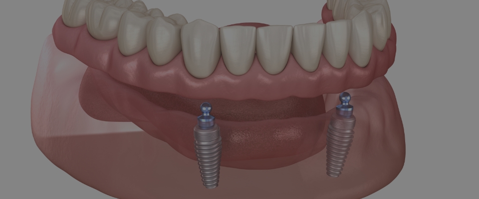 インプラントと磁力で入れ歯を固定する　「インプラントオーバーデンチャー」